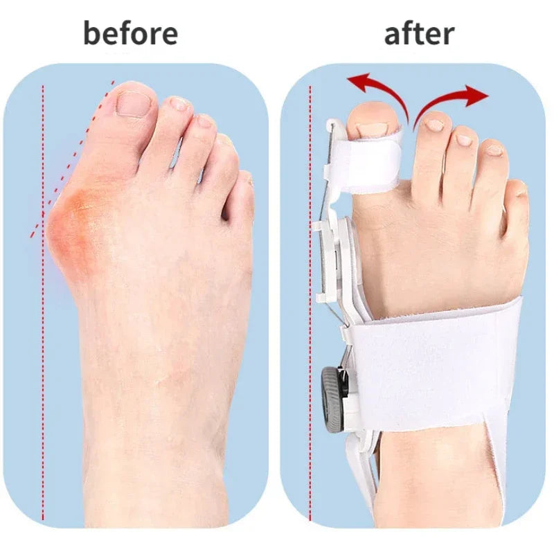 Nuosum - Universal hallux algus corrector