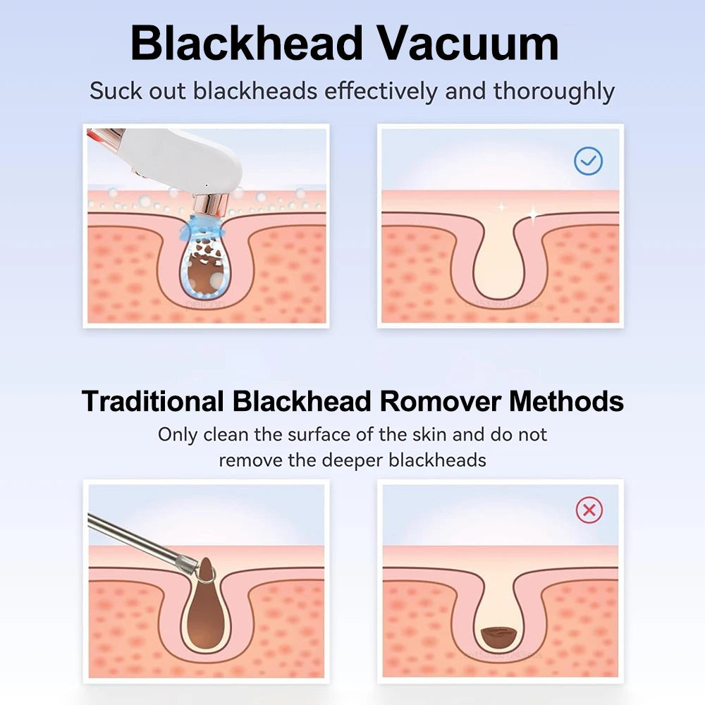 GlowPure - Blackhead Remover